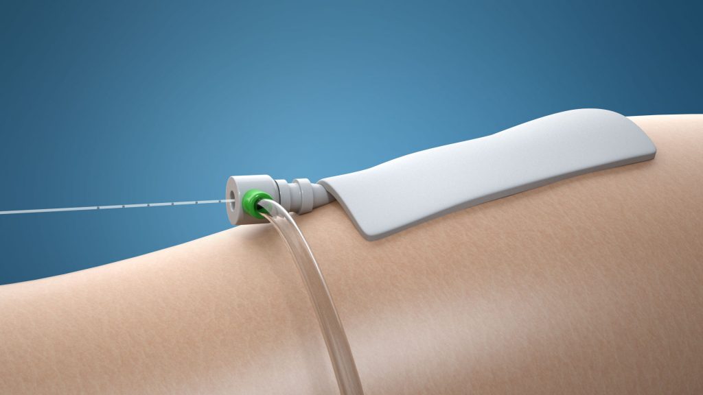 Animacja 3d medyczna usuwanie zylakow 3vo 01 Animacja 3d medyczna usuwanie zylakow 3vo 01