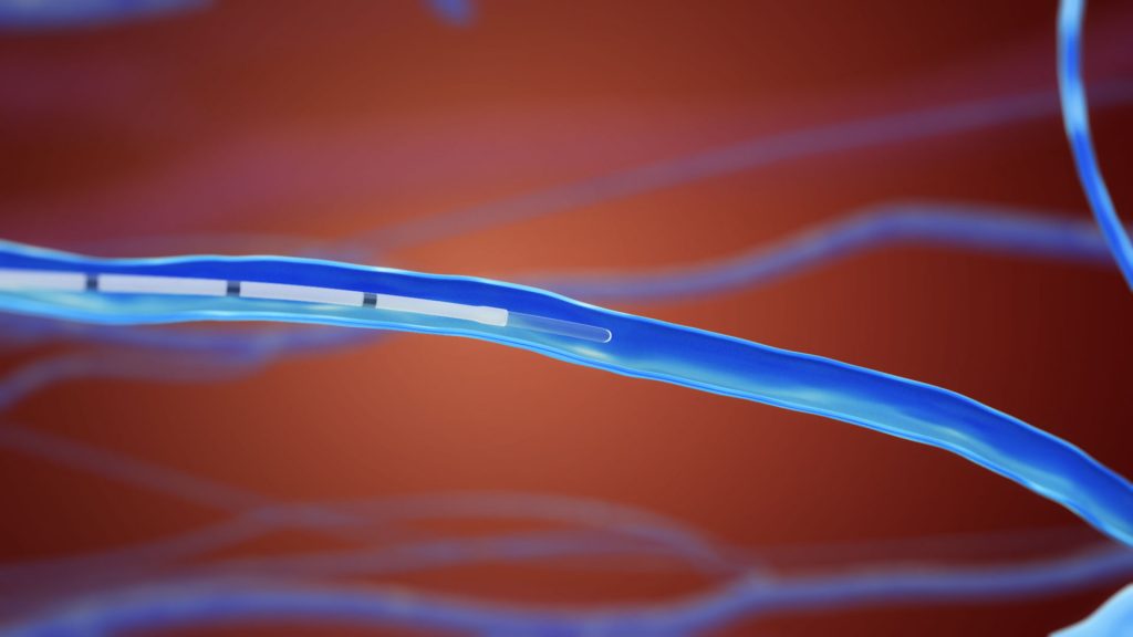 Animacja 3d medyczna usuwanie zylakow 3vo 02 Animacja 3d medyczna usuwanie zylakow 3vo 02