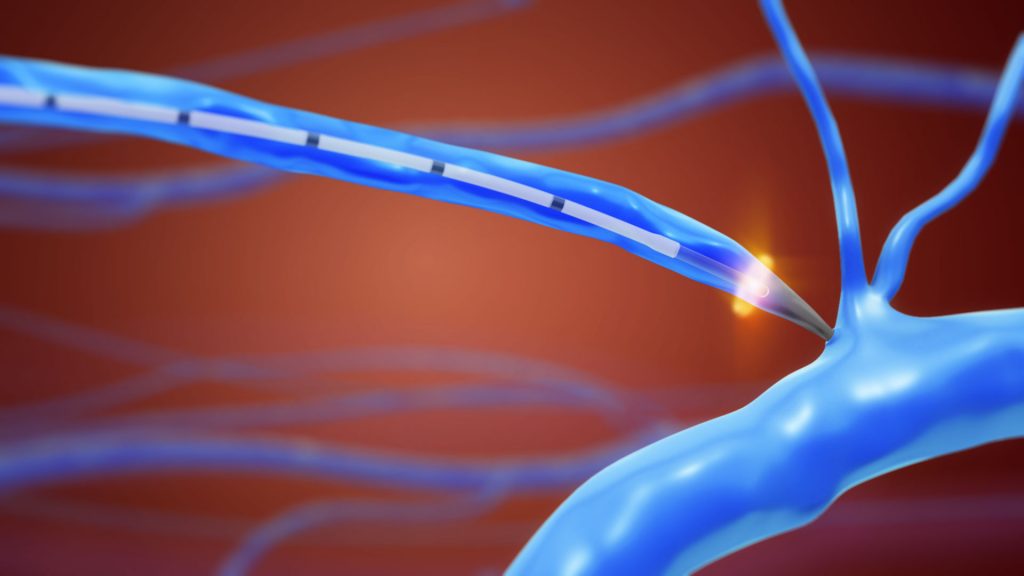 Animacja 3d medyczna usuwanie zylakow 3vo 03 Animacja 3d medyczna usuwanie zylakow 3vo 03