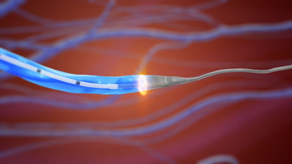 Animacja 3d medyczna usuwanie zylakow 3vo 04 Animacja 3d medyczna usuwanie zylakow 3vo 04