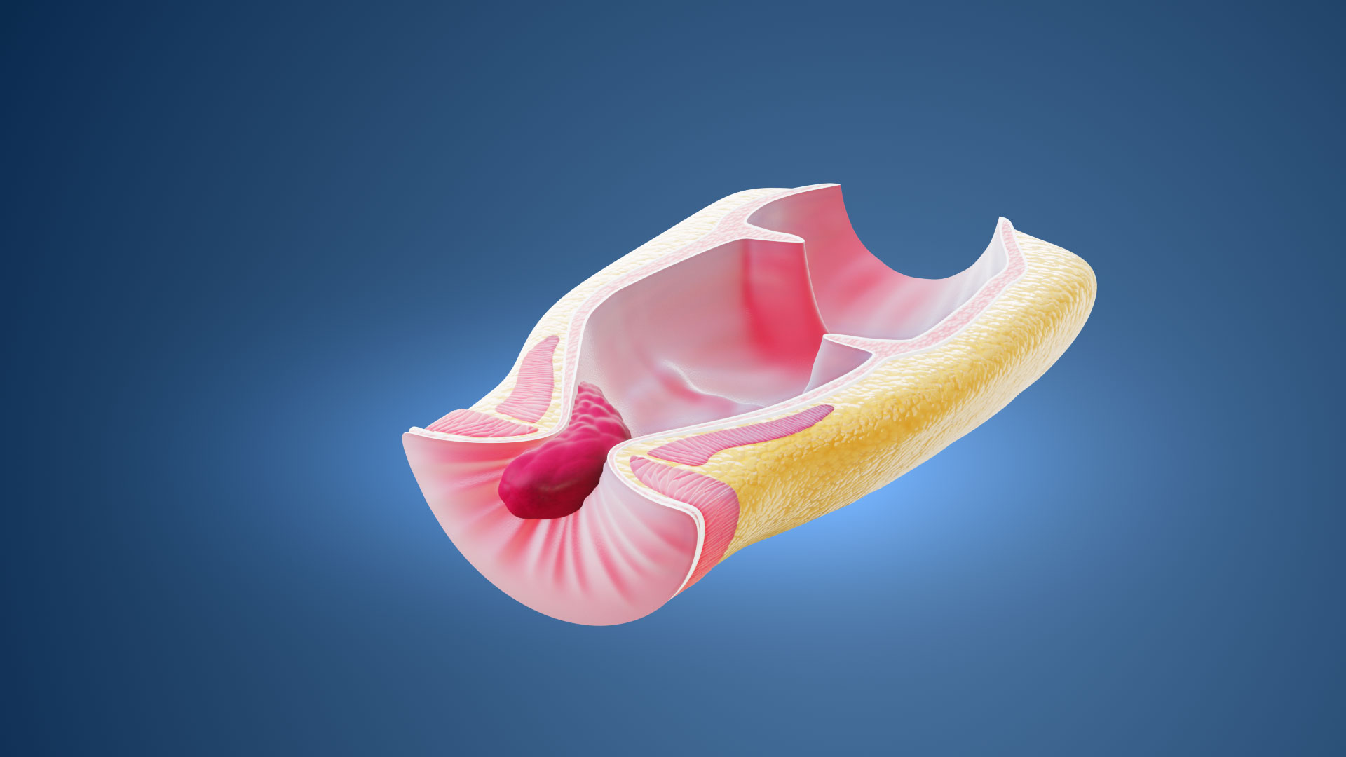 Animacja 3D Hemoroidy