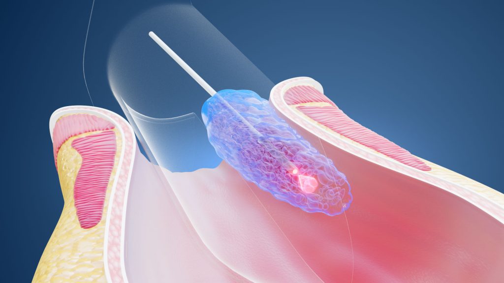 Animacja 3D Hemoroidy 003 Animacja 3D Hemoroidy