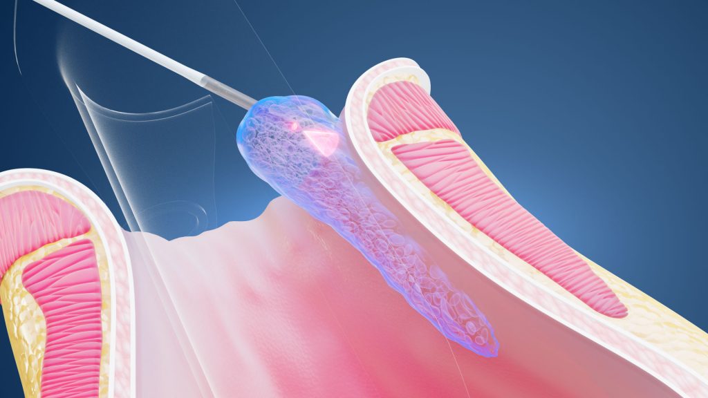 Animacja 3D Hemoroidy 004 Animacja 3D Hemoroidy