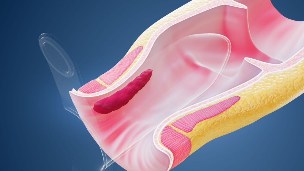 Animacja 3D Hemoroidy 005 Animacja 3D Hemoroidy