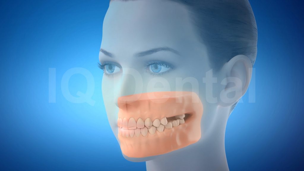 3vo Dentystyczne Animacje 3D 001 3vo Dentystyczne Animacje 3D