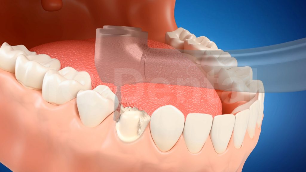 3vo Dentystyczne Animacje 3D 002 3vo Dentystyczne Animacje 3D