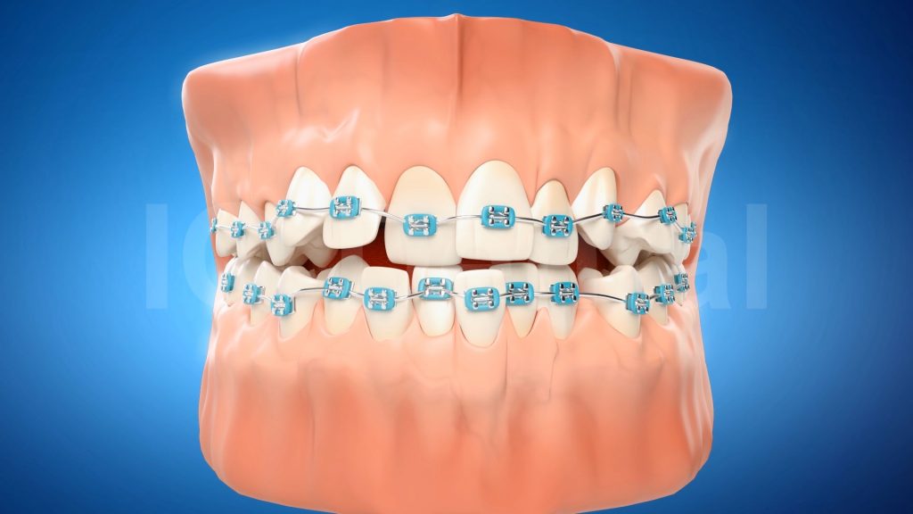 3vo Dentystyczne Animacje 3D 003 3vo Dentystyczne Animacje 3D