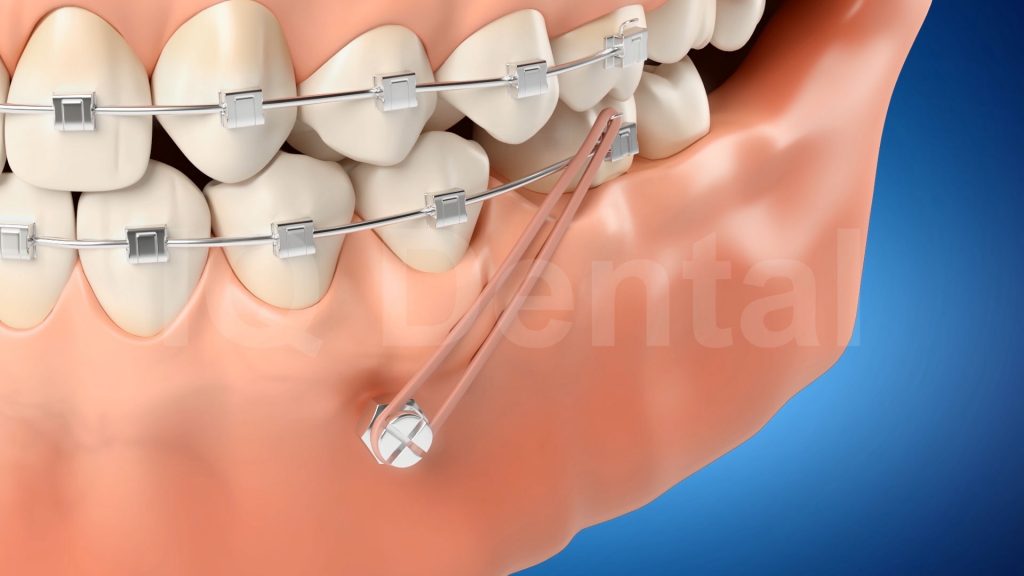 3vo Dentystyczne Animacje 3D 004 3vo Dentystyczne Animacje 3D