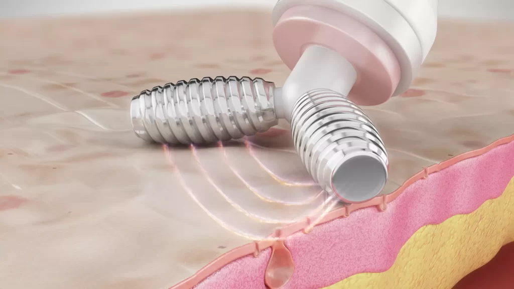 Animacja medyczna 3D Hydroimpact 001 Animacja medyczna 3D Hydroimpact