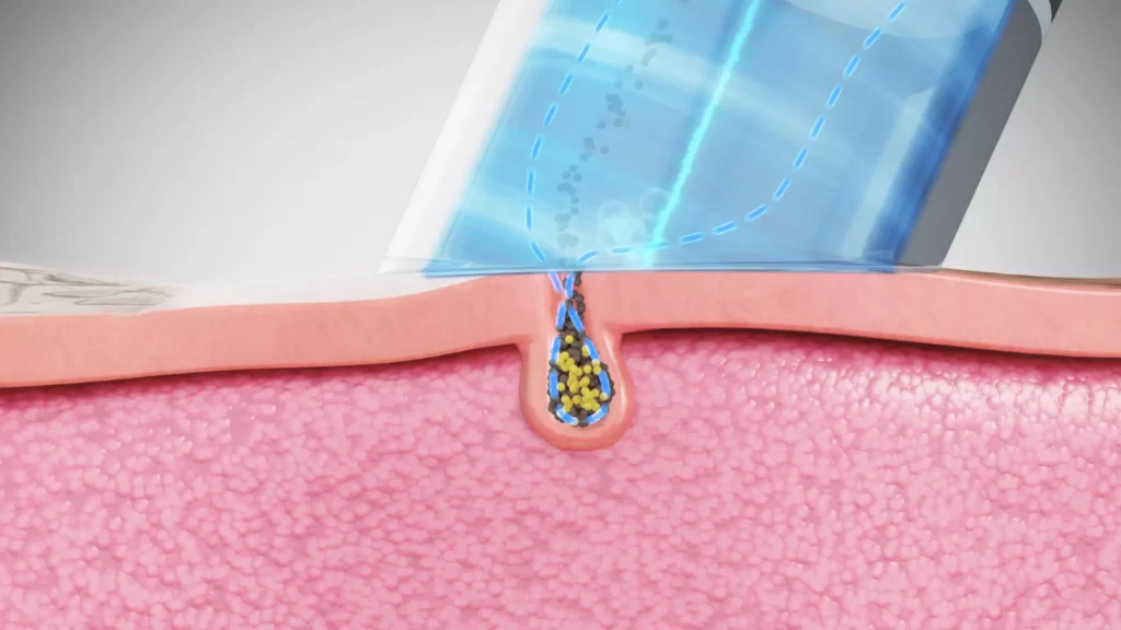 Animacja medyczna 3D Hydroimpact 005 Animacja medyczna 3D Hydroimpact