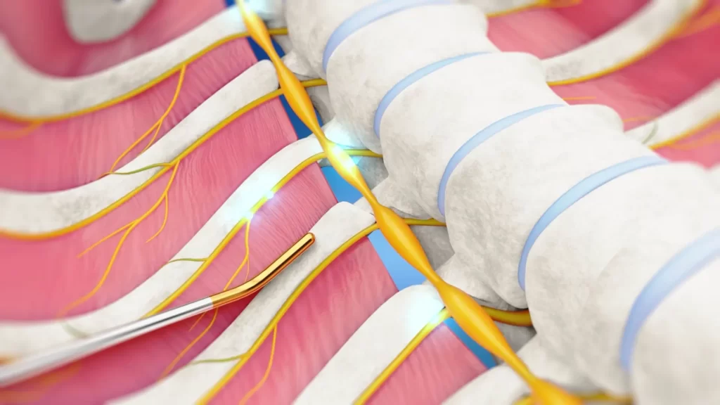 Animacje medyczne 3D Krioanalgezja 3vo Studio 001 Animacje medyczne 3D Krioanalgezja 3vo Studio