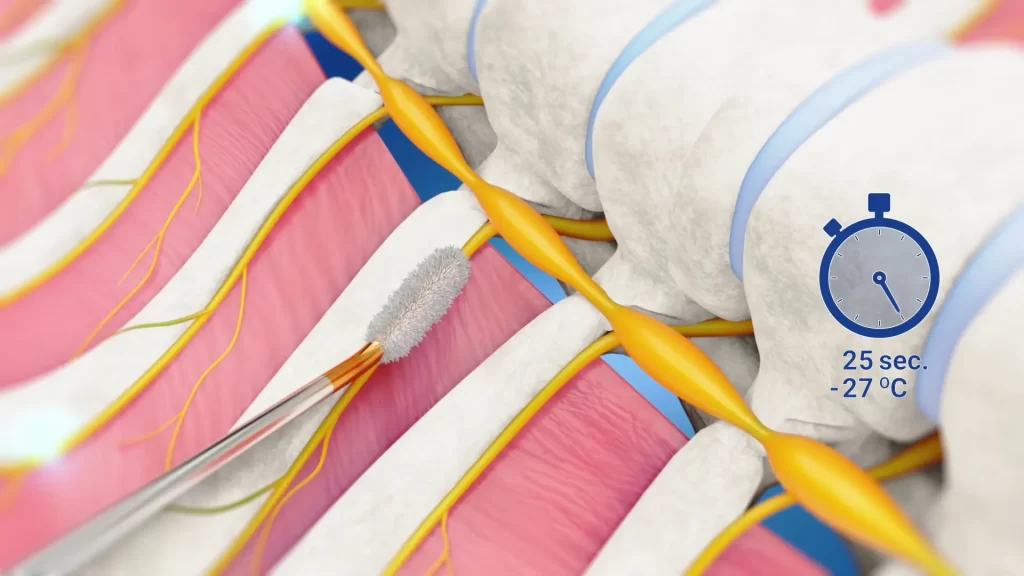 Animacje medyczne 3D Krioanalgezja 3vo Studio 002 Animacje medyczne 3D Krioanalgezja 3vo Studio