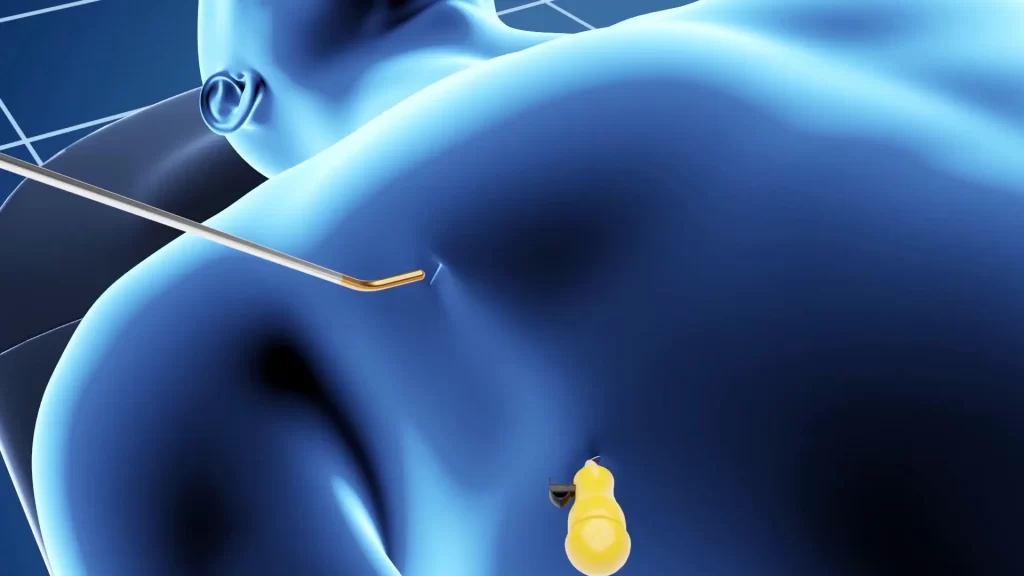 Animacje medyczne 3D Krioanalgezja 3vo Studio 004 Animacje medyczne 3D Krioanalgezja 3vo Studio